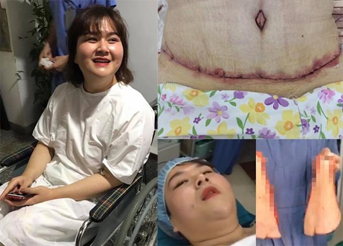 Tiết lộ chi phí Á quân 'Bước nhảy ngàn cân' phẫu thuật cắt bỏ 5kg mỡ bụng - Ảnh 5 Tiết lộ chi phí Á quân 'Bước nhảy ngàn cân' phẫu thuật cắt bỏ 5kg mỡ bụng - Ảnh 5