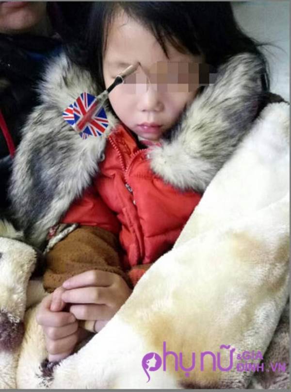 Bé gái 6 tuổi bị anh trai ném phi tiêu đâm vào đầu - Ảnh 2