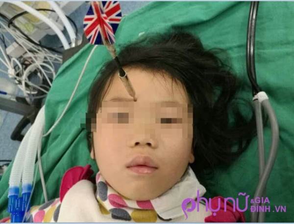 Bé gái 6 tuổi bị anh trai ném phi tiêu đâm vào đầu - Ảnh 1