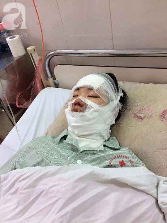 Ngoài cô gái bị bỏng do 55 quả bóng bay, tại Hà Nội có 2 người khác cũng vừa bị bỏng vì lí do này - Ảnh 1