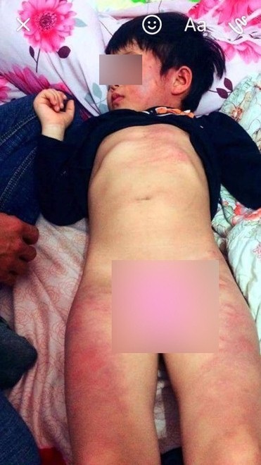Bé gái 4 tuổi bầm tím khắp người nghi bị bạo hành: Cô giáo chủ nhiệm thừa nhận bản thân sơ suất - Ảnh 2 Bé gái 4 tuổi bầm tím khắp người nghi bị bạo hành: Cô giáo chủ nhiệm thừa nhận bản thân sơ suất - Ảnh 2