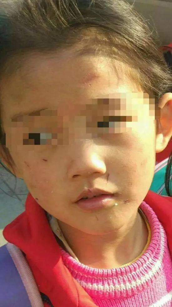 Bé gái 6 tuổi người đầy vết thương, tóc rụng lộ hết da đầu do mẹ ruột bạo hành dã man - Ảnh 1