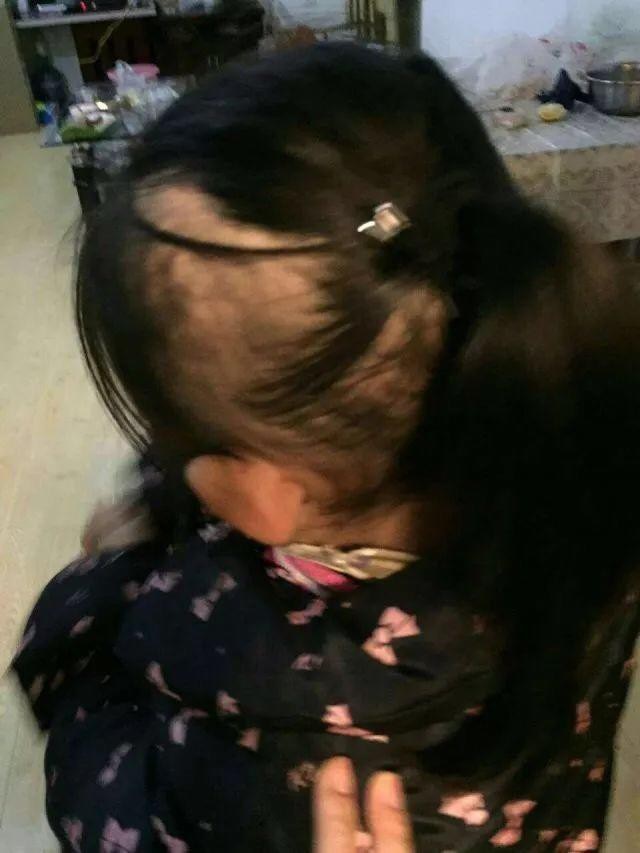 Bé gái 6 tuổi người đầy vết thương, tóc rụng lộ hết da đầu do mẹ ruột bạo hành dã man - Ảnh 3