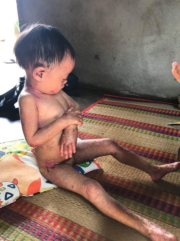 Tiếng khóc xé lòng của bé gái 3 tuổi dân tộc Chơ Ro vừa sinh ra đã bị bóng nước loang lổ nổi đầy người - Ảnh 1 Tiếng khóc xé lòng của bé gái 3 tuổi dân tộc Chơ Ro vừa sinh ra đã bị bóng nước loang lổ nổi đầy người - Ảnh 1
