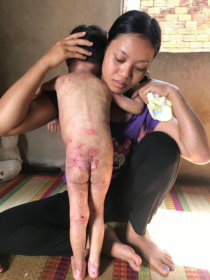 Tiếng khóc xé lòng của bé gái 3 tuổi dân tộc Chơ Ro vừa sinh ra đã bị bóng nước loang lổ nổi đầy người - Ảnh 2 Tiếng khóc xé lòng của bé gái 3 tuổi dân tộc Chơ Ro vừa sinh ra đã bị bóng nước loang lổ nổi đầy người - Ảnh 2