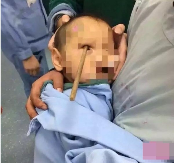 Bé trai 3 tuổi tử vong thương tâm vì bị đũa đâm sâu vào mắt