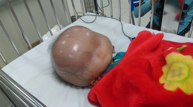 Bé trai mắc não úng thủy ở Thanh Hóa qua đời, nhiều nhà hảo tâm khóc vì xót xa thương cảm - Ảnh 1 Bé trai mắc não úng thủy ở Thanh Hóa qua đời, nhiều nhà hảo tâm khóc vì xót xa thương cảm - Ảnh 1