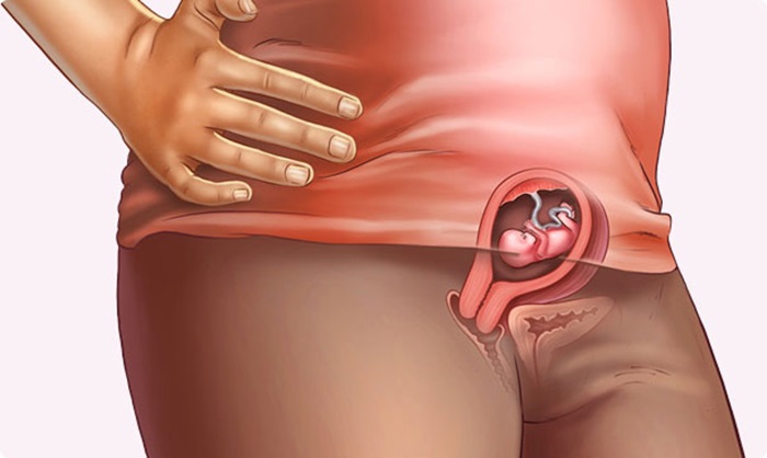Bị bệnh trĩ khi mang thai các chị em sẽ dễ mắc các bệnh viêm nhiễm phụ khoa.