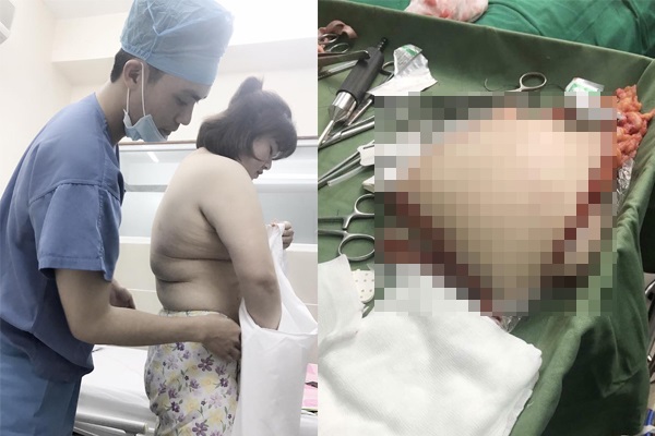 Tiết lộ chi phí Á quân 'Bước nhảy ngàn cân' phẫu thuật cắt bỏ 5kg mỡ bụng - Ảnh 2 Tiết lộ chi phí Á quân 'Bước nhảy ngàn cân' phẫu thuật cắt bỏ 5kg mỡ bụng - Ảnh 2