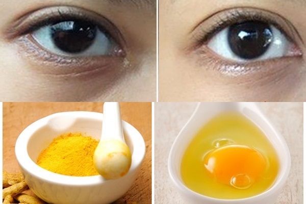 Bị thâm quầng mắt dưới sẽ biến mất khi áp dụng nghệ và trứng gà
