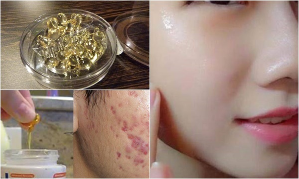 Trị thâm nám, sẹo rõ cấp tốc với cách chăm sóc da mặt bằng vitamin E Trị thâm nám, sẹo rõ cấp tốc với cách chăm sóc da mặt bằng vitamin E