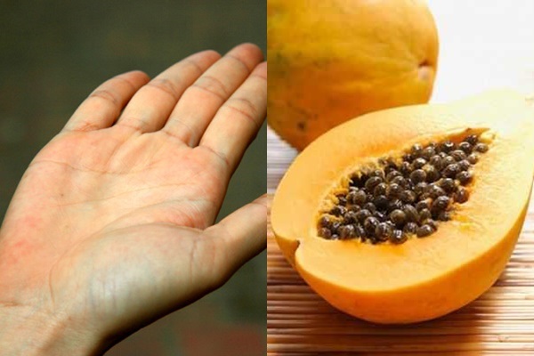 Dùng đu đủ là cách chữa chai tay hiệu quả mà an toàn Dùng đu đủ là cách chữa chai tay hiệu quả mà an toàn