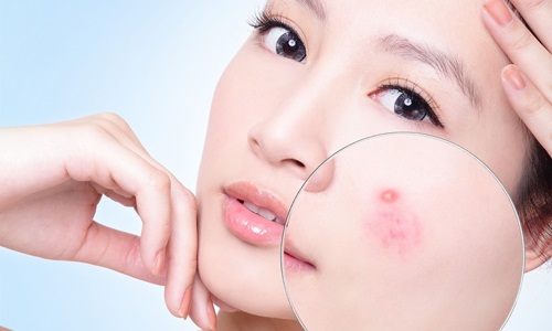 Mách bạn cách trang điểm che mụn đơn giản nhất - Ảnh 1 Hiểu về da mụn để có cách trang điểm phù hợp