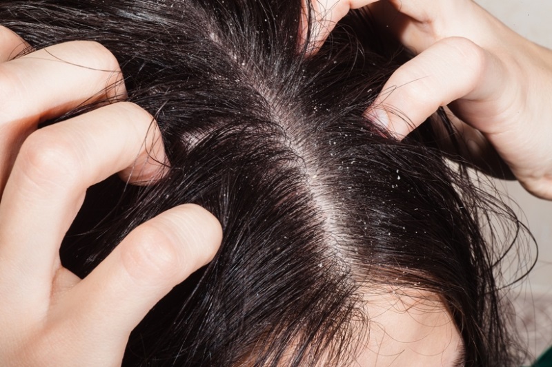 Cần tìm cách loại bỏ chấy nhanh và hiệu quả để trả lại da đầu khỏe mạnh