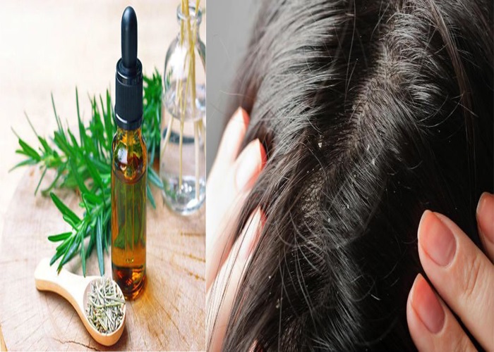Cách trị gàu hiệu quả cho nữ bằng tinh dầu hương thảo