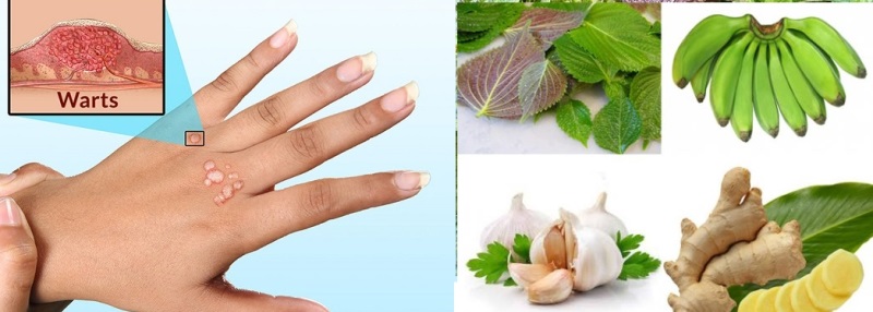 Hướng dẫn các bạn cách trị mụn cóc dân gian an toàn và chất lượng nhất