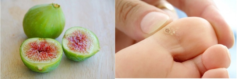 Nhựa sung trị mụn cóc cũng rất đơn giản và nhanh chóng