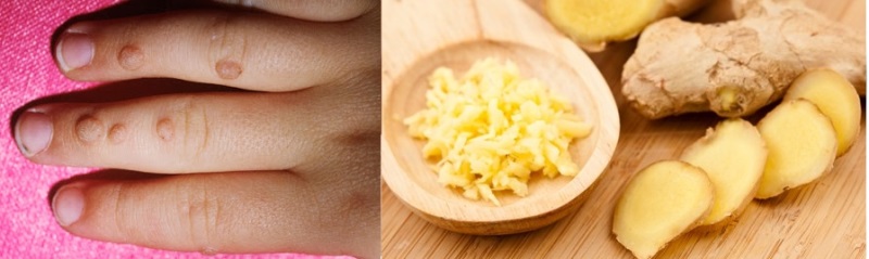 Cách trị mụn cóc dân gian bằng gừng hiệu quả không kém cách trị mụn cóc bằng tỏi đâu nhé