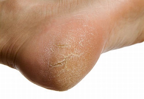 Gót chân khô nứt nẻ cần có cách điều trị hiệu quả nhất