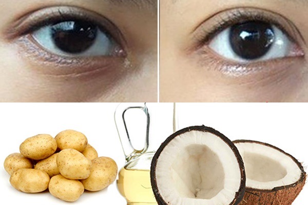 Kết hợp dầu dừa và khoai tây trị thâm quầng mắt hiệu quả cao