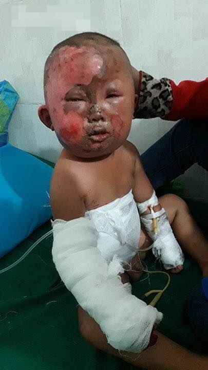 Nỗi đau đớn khủng khiếp của em bé H’Mông 3 tuổi chui ra từ đống cỏ khô đang cháy sau phút lơ là của người mẹ trẻ - Ảnh 1 Nỗi đau đớn khủng khiếp của em bé H’Mông 3 tuổi chui ra từ đống cỏ khô đang cháy sau phút lơ là của người mẹ trẻ - Ảnh 1