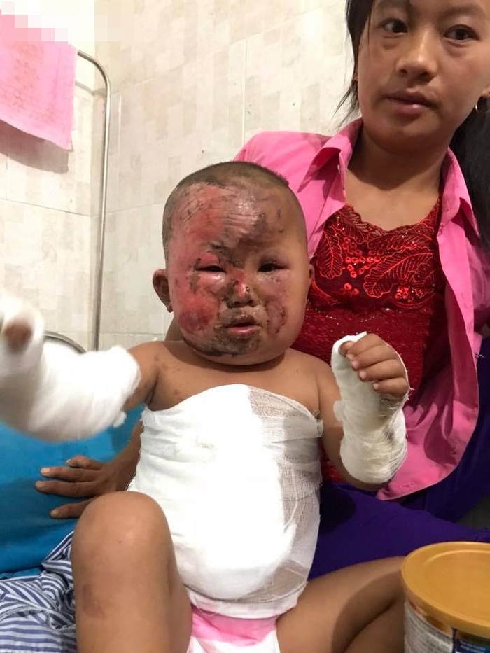 Nỗi đau đớn khủng khiếp của em bé H’Mông 3 tuổi chui ra từ đống cỏ khô đang cháy sau phút lơ là của người mẹ trẻ - Ảnh 4 Nỗi đau đớn khủng khiếp của em bé H’Mông 3 tuổi chui ra từ đống cỏ khô đang cháy sau phút lơ là của người mẹ trẻ - Ảnh 4