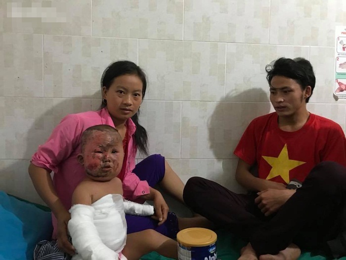 Nỗi đau đớn khủng khiếp của em bé H’Mông 3 tuổi chui ra từ đống cỏ khô đang cháy sau phút lơ là của người mẹ trẻ - Ảnh 3 Nỗi đau đớn khủng khiếp của em bé H’Mông 3 tuổi chui ra từ đống cỏ khô đang cháy sau phút lơ là của người mẹ trẻ - Ảnh 3