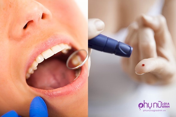 Cảnh báo: Thấy dấu hiệu này ở nướu, bạn có thể đã mắc bệnh tiểu đường - Ảnh 1 Cảnh báo: Thấy dấu hiệu này ở nướu, bạn có thể đã mắc bệnh tiểu đường - Ảnh 1