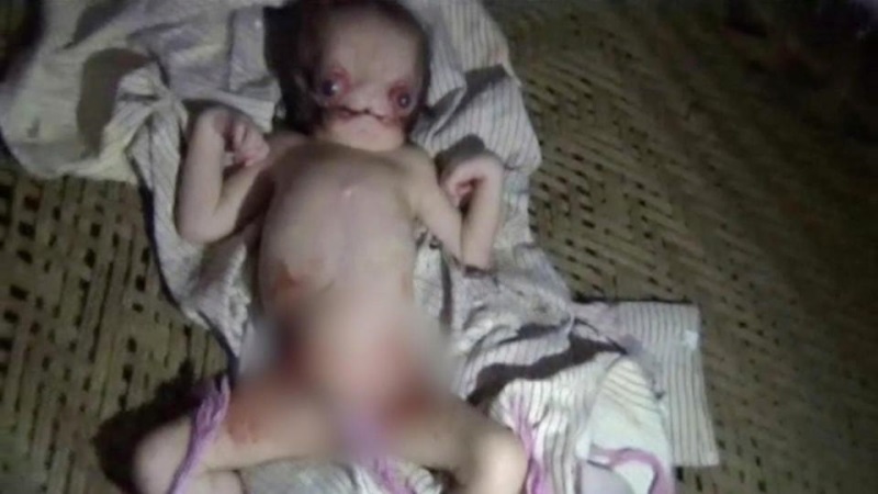 Sinh con dị dạng bị người đời xa lánh, cha mẹ vẫn kiên quyết: 'Chúng tôi sẽ không bỏ con' - Ảnh 3 Sinh con dị dạng bị người đời xa lánh, cha mẹ vẫn kiên quyết giữ lại