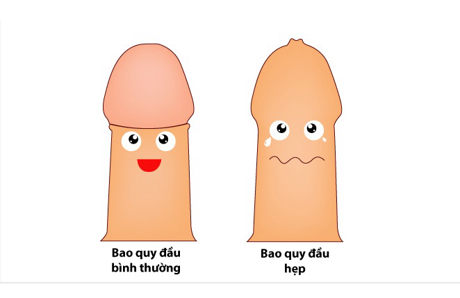 Hẹp bao quy đầu: Thủ phạm khiến chàng sợ làm 'chuyện ấy' - Ảnh 1 Hẹp bao quy đầu: Thủ phạm khiến chàng sợ làm 'chuyện ấy' - Ảnh 1