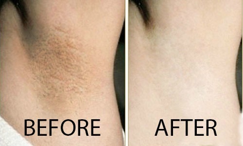 Mẹo làm trắng da, trị mụn siêu nhanh với khoai tây