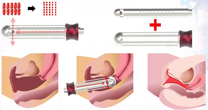 Phẫu thuật thu hẹp vùng kín - Phương pháp hiện đại nhất hiện nay. Phẫu thuật thu hẹp vùng kín - Phương pháp hiện đại nhất hiện nay.