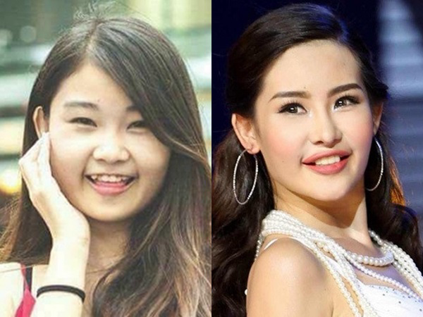 Lộ hình ảnh mới chứng minh Hoa hậu Đại dương từng chỉnh răng như lời tố của Nguyễn Thị Thành - Ảnh 9