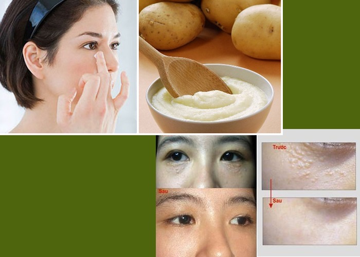 Lạ lùng với mẹo trị mụn thịt dân gian mang lại “phép màu” cho làn da - Ảnh 1 Mẹo trị mụn thịt dân gian với khoai tây xay nhuyễn