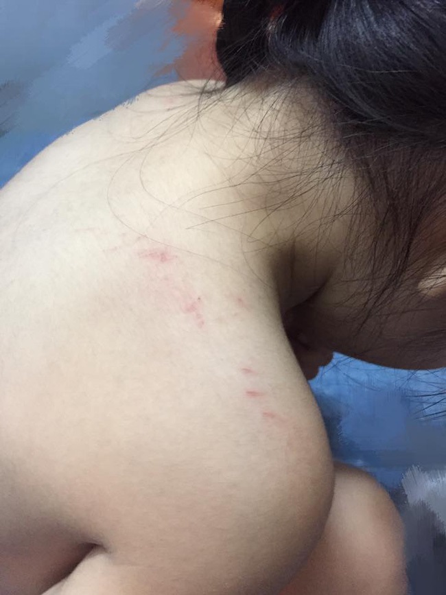 Phụ huynh bức xúc tố cô giáo trường MN quốc tế đánh con gái 3 tuổi trầy xước khắp người - Ảnh 1