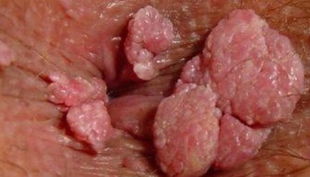 Quan hệ đồng giới và những mối nguy bệnh tình dục cần tránh - Ảnh 1 Quan hệ đồng giới và những mối nguy bệnh tình dục cần tránh - Ảnh 1