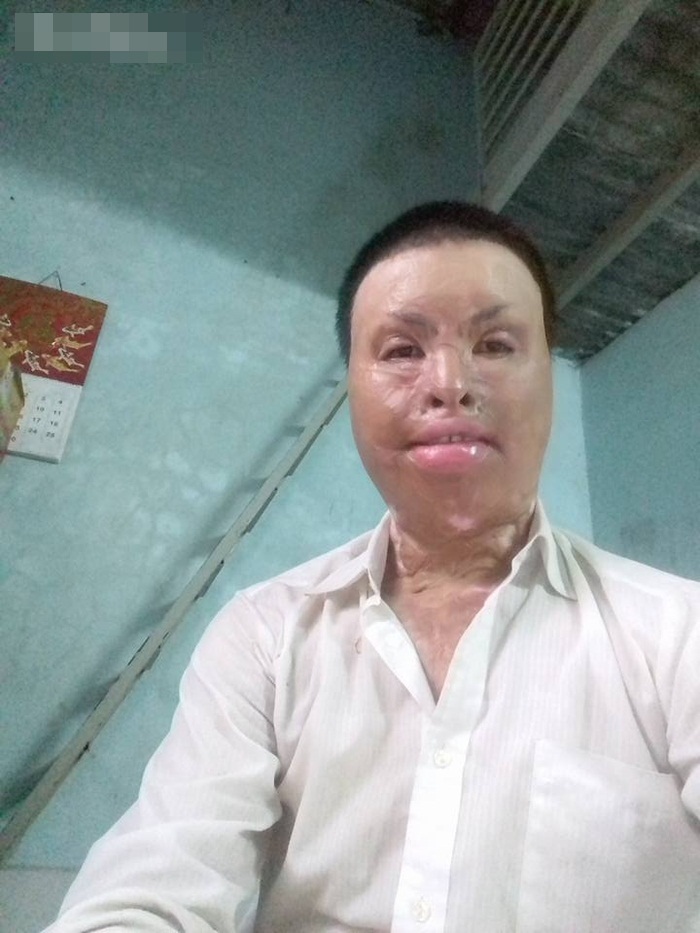 Số phận nghiệt ngã của người thợ sửa xe máy bị xăng thiêu sống biến thành dị nhân - Ảnh 1 Số phận nghiệt ngã của người thợ sửa xe máy bị xăng thiêu sống biến thành dị nhân - Ảnh 1