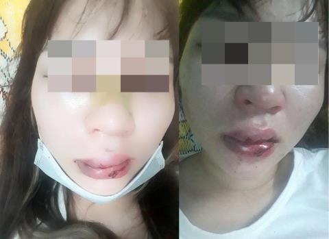 Chuyện thật như đùa: Cứu người gặp nạn, cô gái xinh đẹp được ‘trả ơn’ bằng cú đánh rách miệng, lệch sống mũi - Ảnh 3 Chuyện thật như đùa: Cứu người gặp nạn, cô gái xinh đẹp được ‘trả ơn’ bằng cú đánh rách miệng, lệch sống mũi - Ảnh 3