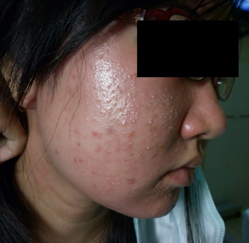 Cảnh báo: Da hỏng vĩnh viễn vì dùng kem trộn Cảnh báo: Da hỏng vĩnh viễn vì dùng kem trộn