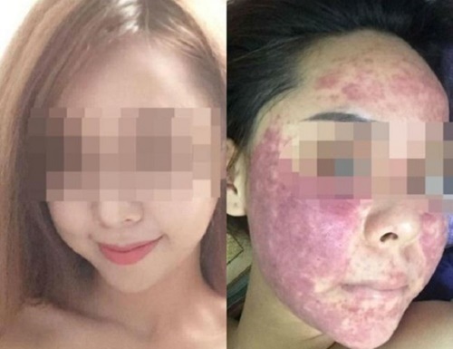 Cảnh báo: Da hỏng vĩnh viễn vì dùng kem trộn Cảnh báo: Da hỏng vĩnh viễn vì dùng kem trộn