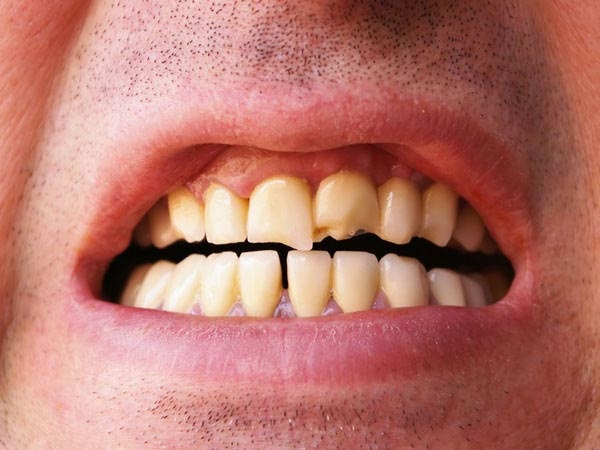 Nguy hiểm: Thói quen sau khi ăn này đang gây hại khủng khiếp cho răng và nướu - Ảnh 2 Nguy hiểm: Thói quen sau khi ăn này đang gây hại khủng khiếp cho răng và nướu - Ảnh 2