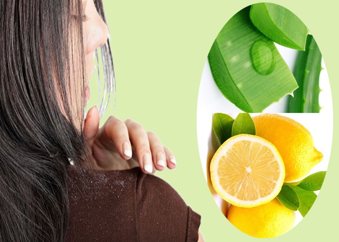 Cách trị gàu bằng nha đam và chanh tươi