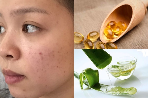 Chỉ 10 phút mỗi ngày trị mụn thâm bằng vitamin E đánh bay vết mụn nhanh nhất - Ảnh 3 Trị mụn thâm bằng vitamin E và nha đam công hiệu vượt trội