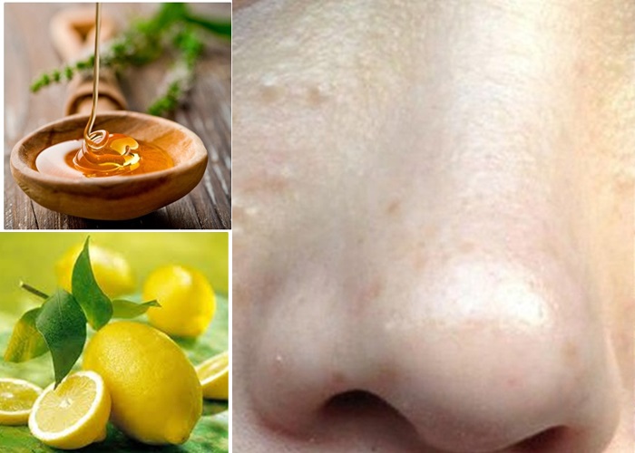 Trị mụn thịt bằng mật ong – Tuyệt chiêu “tống tiễn” mụn thịt nhanh chóng giúp da đẹp hoàn hảo - Ảnh 1 Trị mụn thịt bằng mật ong và nước cốt chanh