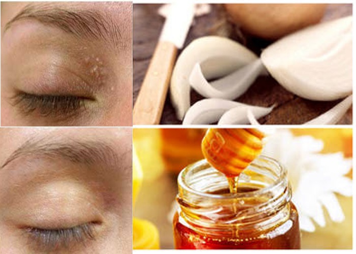 Trị mụn thịt bằng mật ong – Tuyệt chiêu “tống tiễn” mụn thịt nhanh chóng giúp da đẹp hoàn hảo - Ảnh 2 Cách trị mụn thịt bằng mật ong và hành tây