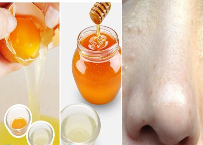 Trị mụn thịt bằng mật ong – Tuyệt chiêu “tống tiễn” mụn thịt nhanh chóng giúp da đẹp hoàn hảo - Ảnh 3 Cách trị mụn thịt bằng mật ong và lòng trắng trứng