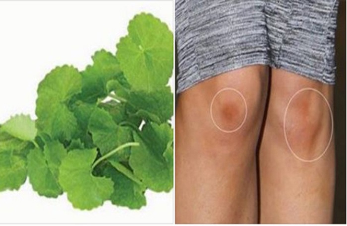 Trị sẹo thâm ở chân lâu năm bằng rau má mang đến hiệu quả bất ngờ cho làn da - Ảnh 1 Trị sẹo thâm ở chân lâu năm bằng rau má mang lại hiệu quả tốt cho người điều trị.