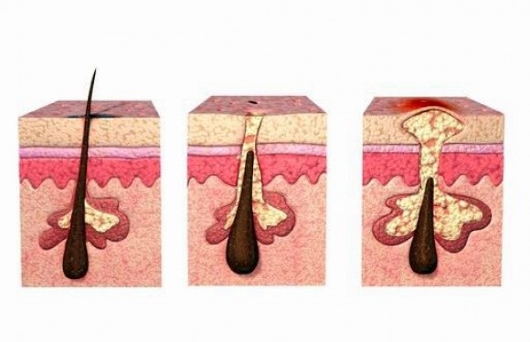 Phụ nữ và bệnh khó nói: Cách đề phòng viêm nang lông vùng kín hiệu quả - Ảnh 2 Phụ nữ và bệnh khó nói: Cách đề phòng viêm nang lông vùng kín hiệu quả - Ảnh 2