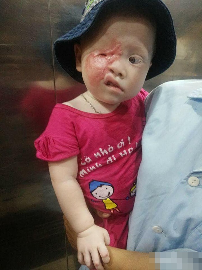 Tương lai vô định của bé gái 2 tuổi bạch tạng bị hỏng một mắt, sẹo bỏng chằng chịt khuôn mặt - Ảnh 2
